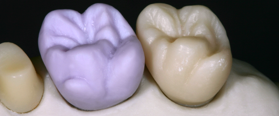 maschinell gefräste Kronen in Lithium-Disilikat (violett) und in Zirkon (weiß)